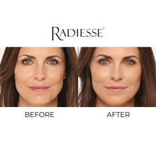 Load image into Gallery viewer, Radiesse®
